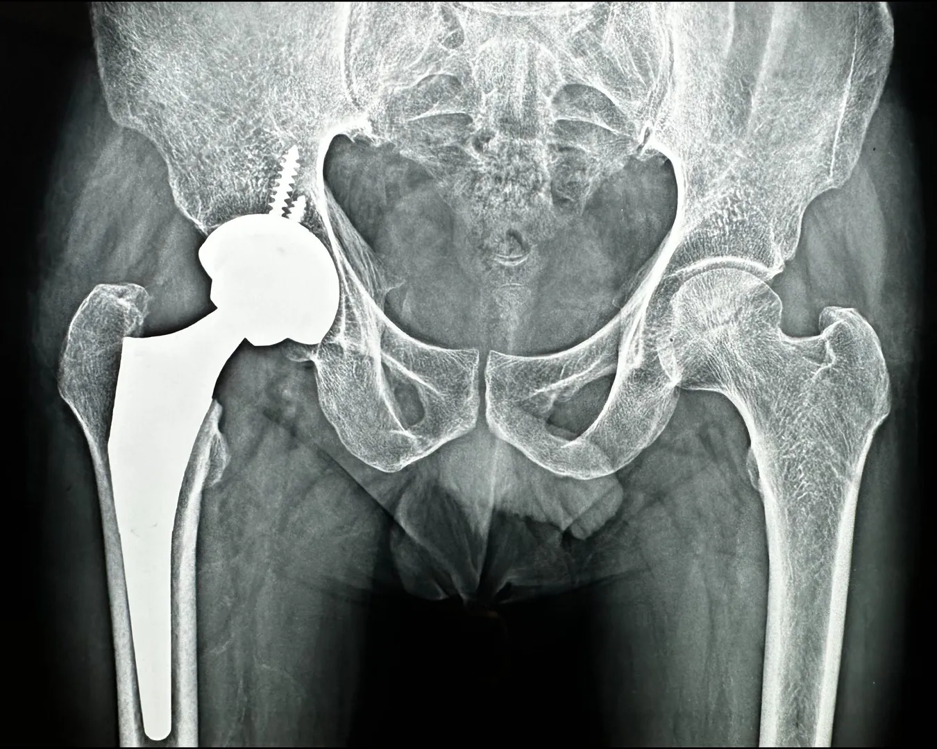 Hip Replacement in Nagpur – A Reliable Solution for Lasting Relief