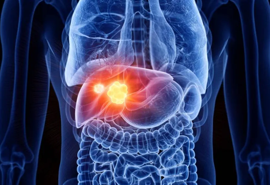 Liver Cancer Management in Nashik