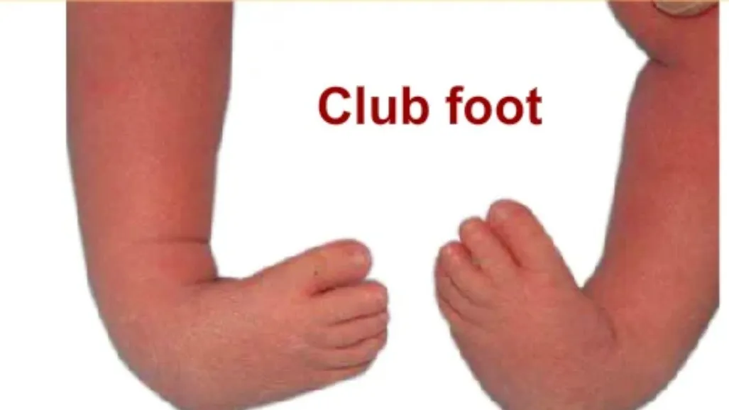 Clubfoot Treatment Doctor in Nagpur