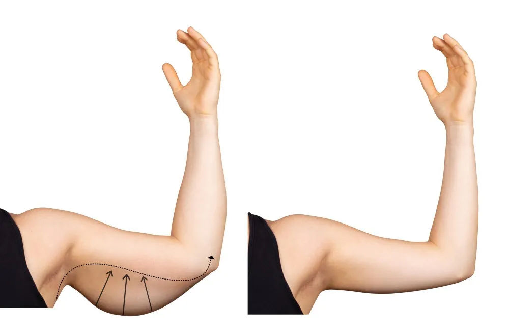 Arm Lift Surgery in Bangalore – Restore Firm and Toned Arms
