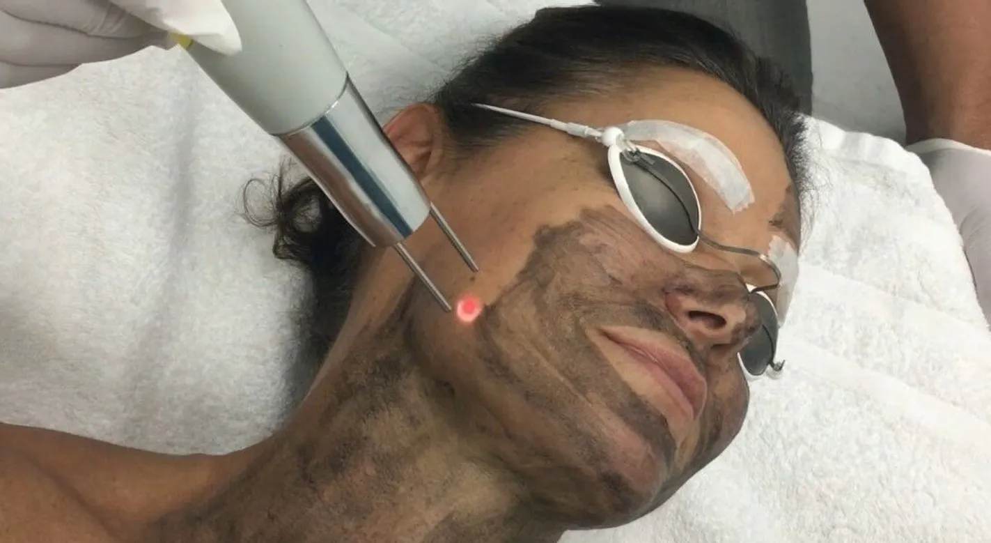 Carbon Peel Treatment in Rajouri Garden