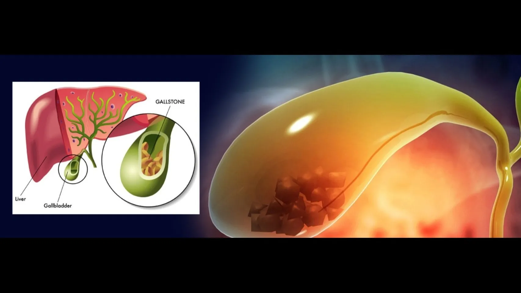 Gallbladder Removal Expert in Surana Sethia – Advanced Laparoscopic Solutions