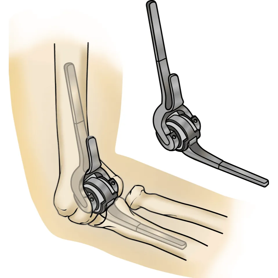 Affordable Joint Replacement Surgery In Shalimar Bagh