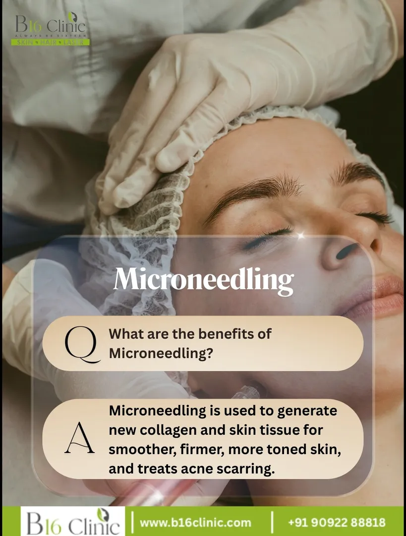 Microneedling treatment in coimbatore