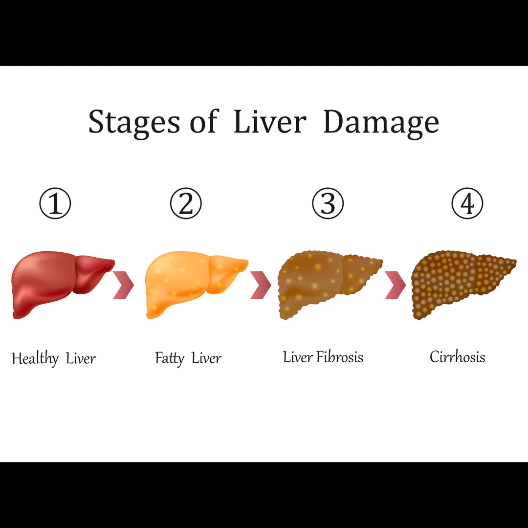 Liver Fibrosis Stages in Mumbai
