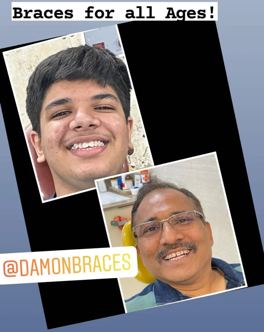 Discover the difference between braces for children and adults. Visit Align and Smile Dental Clinic,