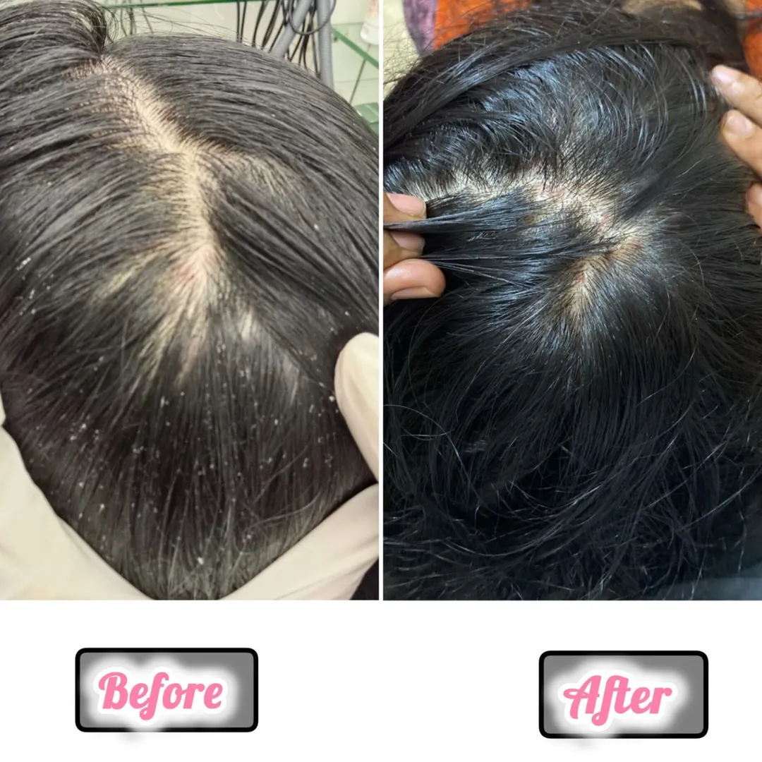 Best dandruff specialist in Belapur