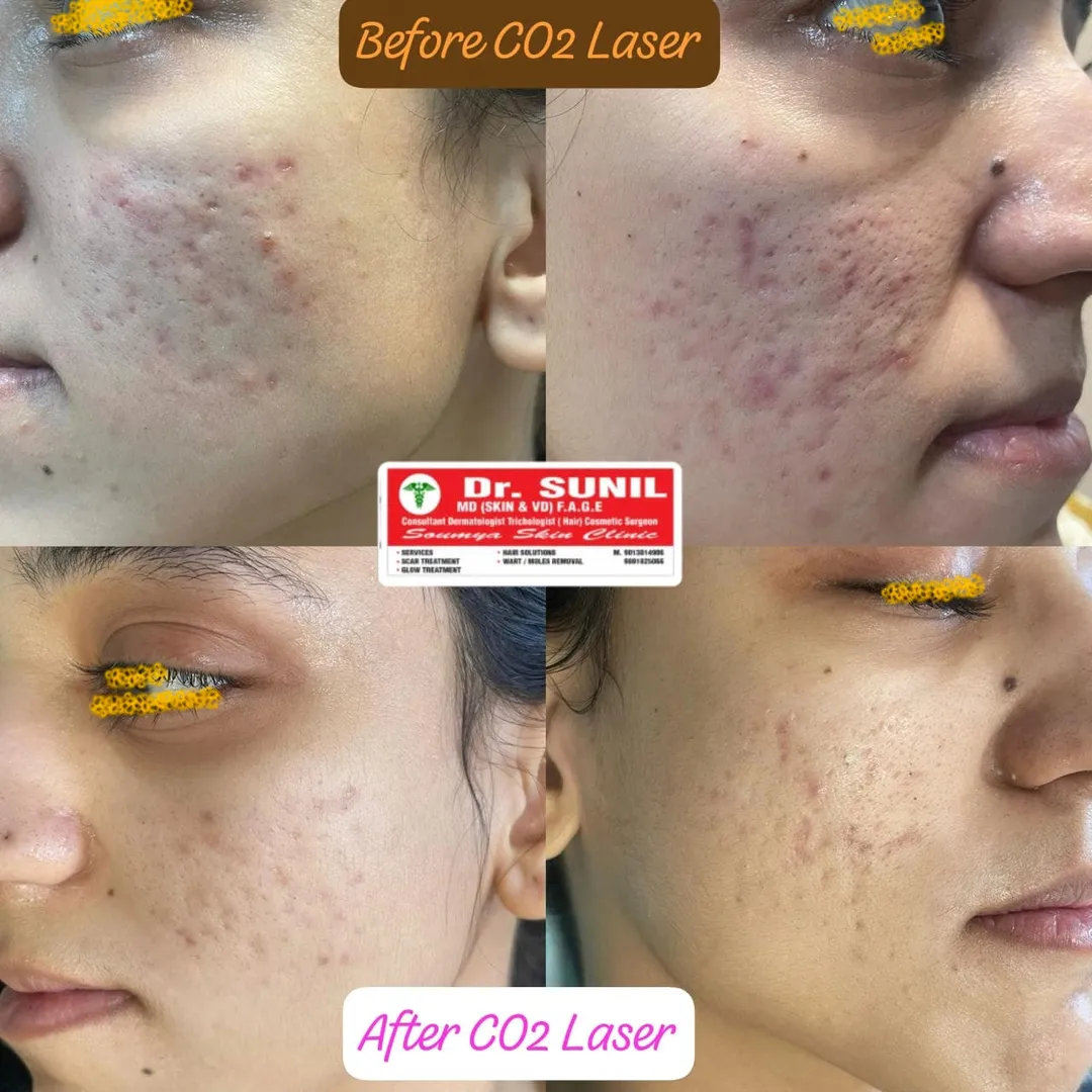 Acne Scar treatment in Rajouri Garden