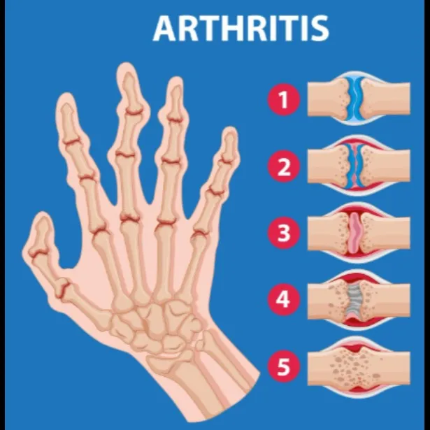 Arthritis Doctor in Nagpur – suyog hospital nagpur