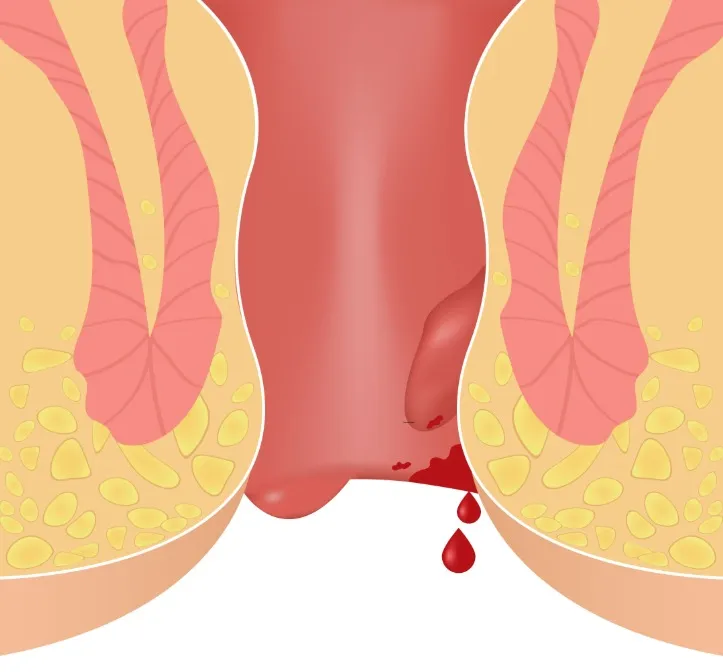 Piles Surgeon in Kolathur, Chennai