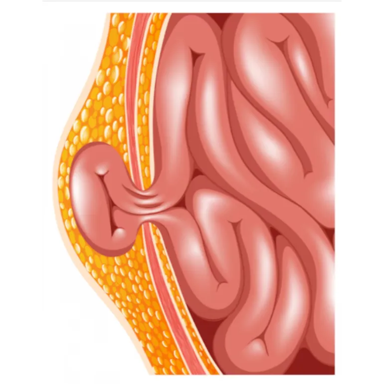 Hernia Treatment in Punawale – Safe and Effective Surgery