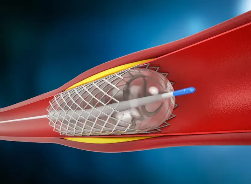 Angiography and Angioplasty in Pune