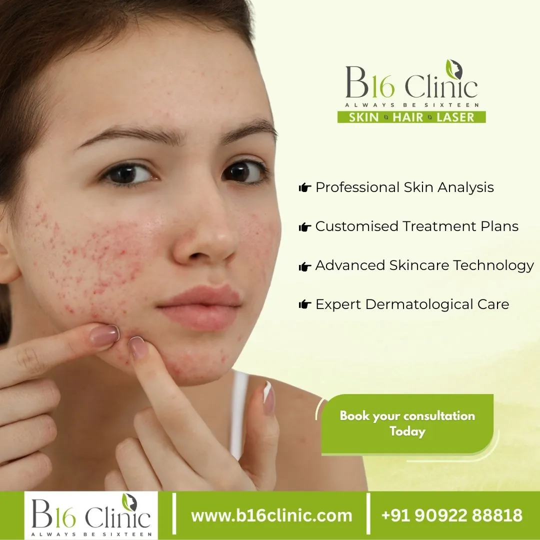 Acne Treatment in Coimbatore
