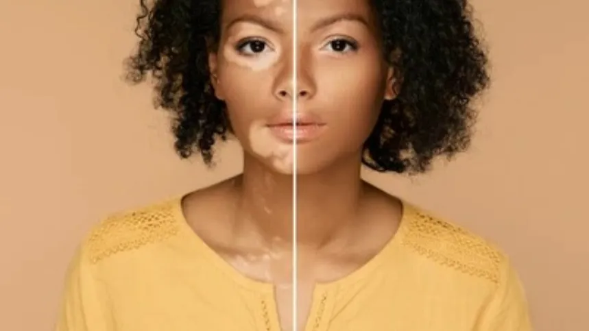 Vitiligo Surgery in Delhi