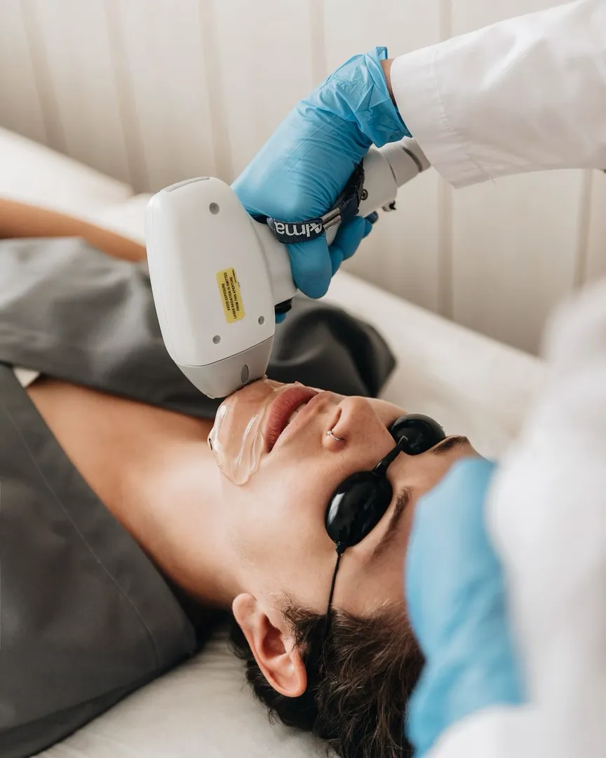 laser hair removal