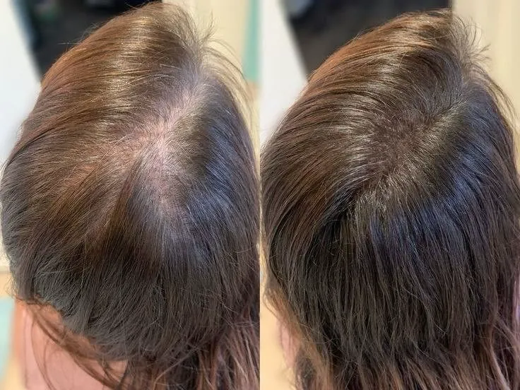 hair GFC treatment