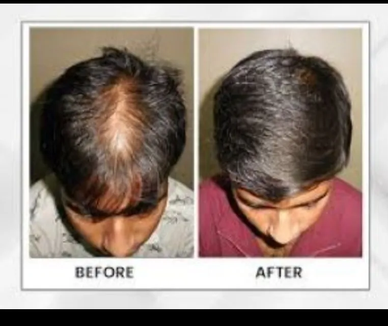 Best Hair Specialist in Dhule for Hair Loss Treatment – Gindodia Hospital