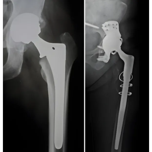 Revision Hip Replacement in Bangalore – Restoring Strength and Comfort