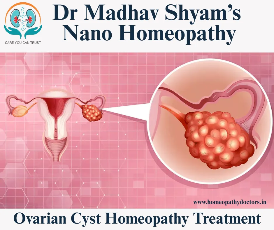 Ovarian cyst Homeopathy Treatment