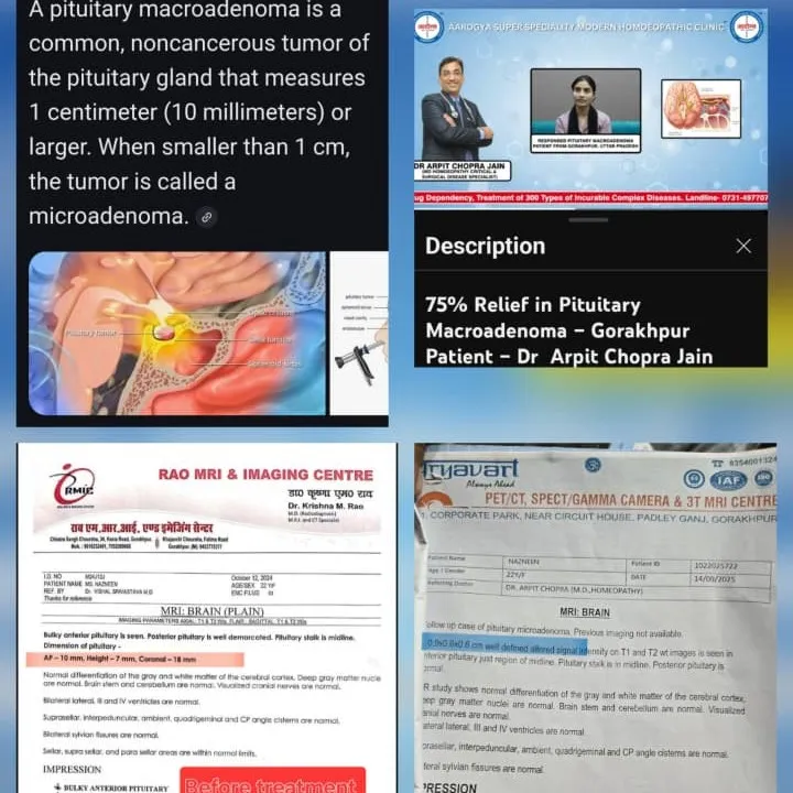 Brain Tumor Pituitary Macroadenoma Responded Lesion 10×7×18 MM to 9×6×6 MM by Dr Arpit Chopra Jain A...