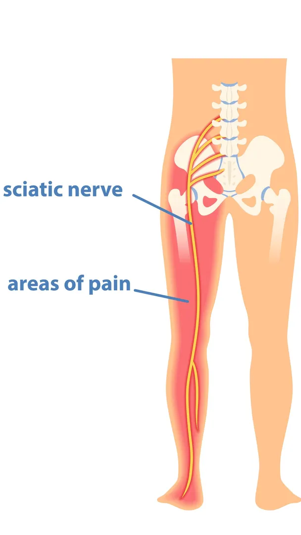 Sciatica Orthopedic Doctor in Nagpur – SUYOG HOSPITAL NAGPUR