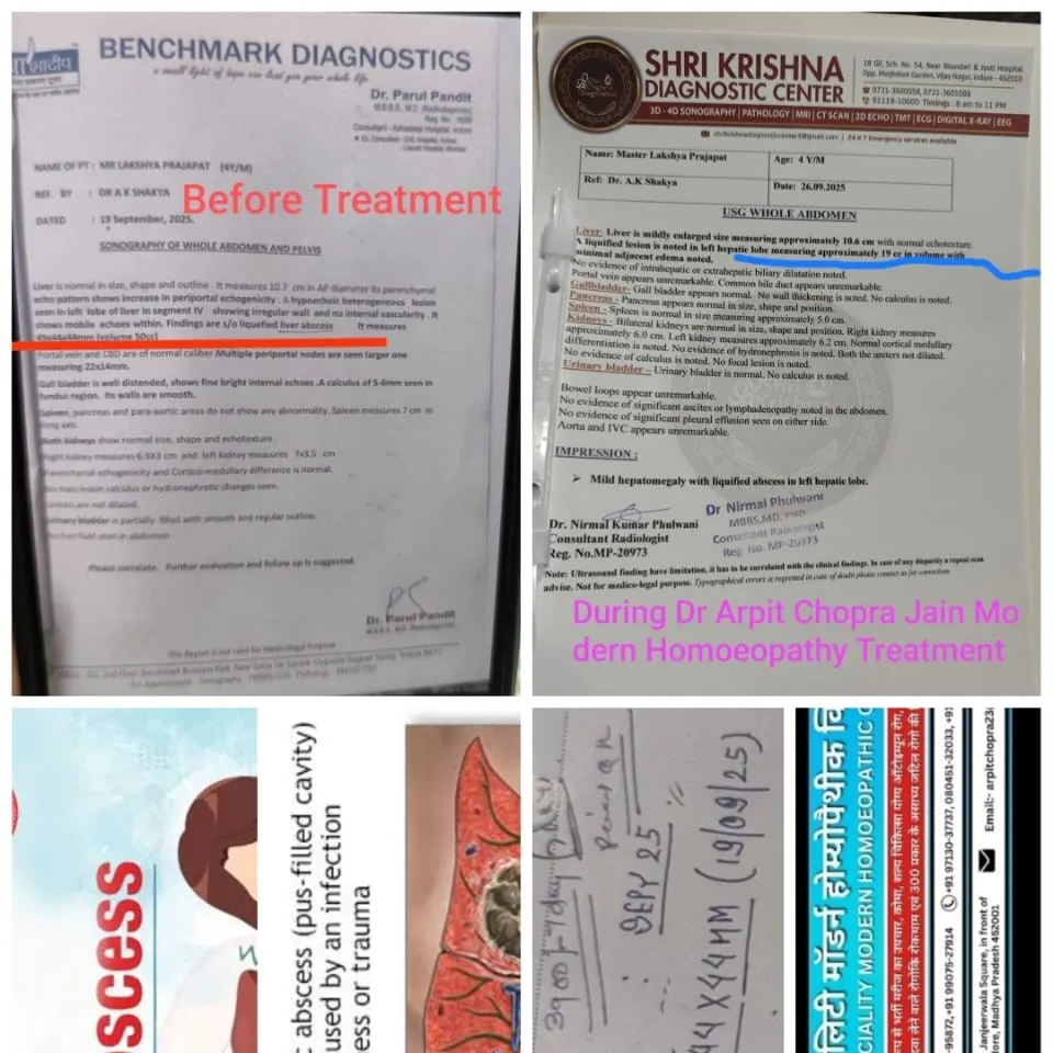 Liver Abscess Responded 49 cc to 19 cc to save surgical intervention & Liver Disease by Aarogya sup...