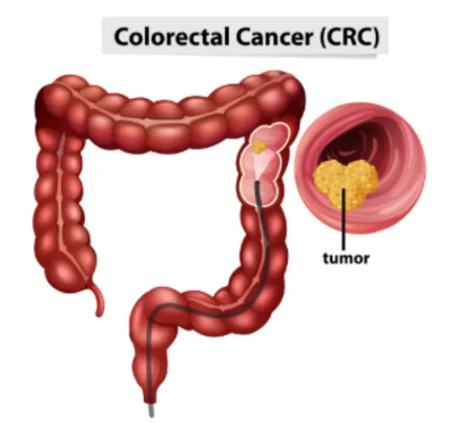 Colon Cancer Screening in Mumbai