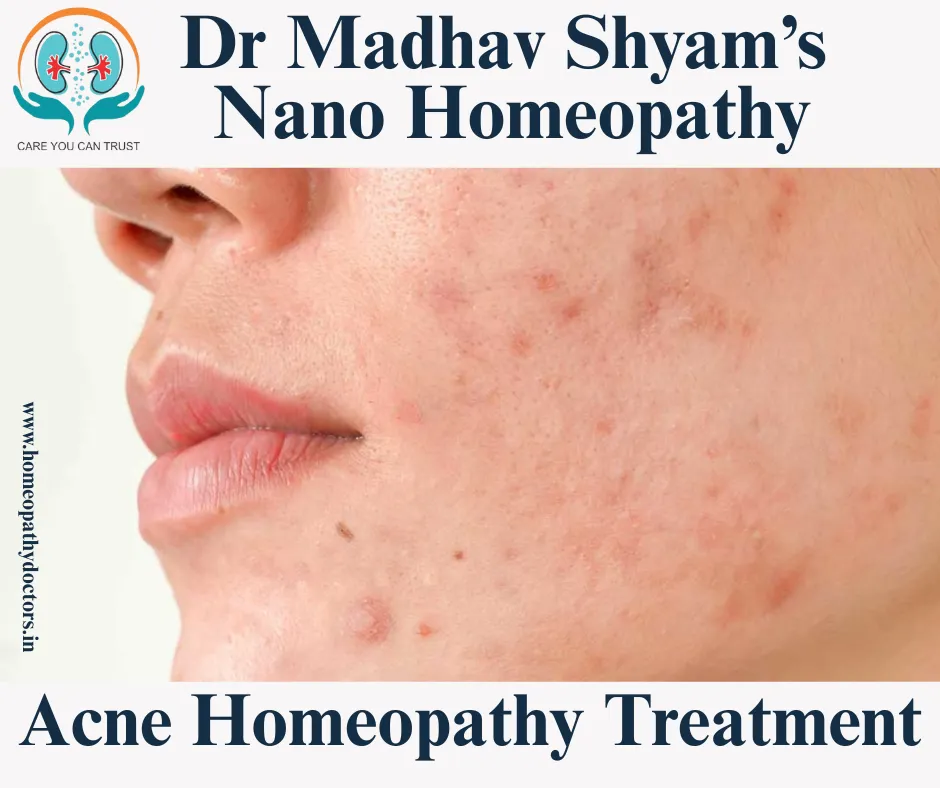 Here’s an overview of homeopathic treatment options for acne. These remedies are usually selected ba...