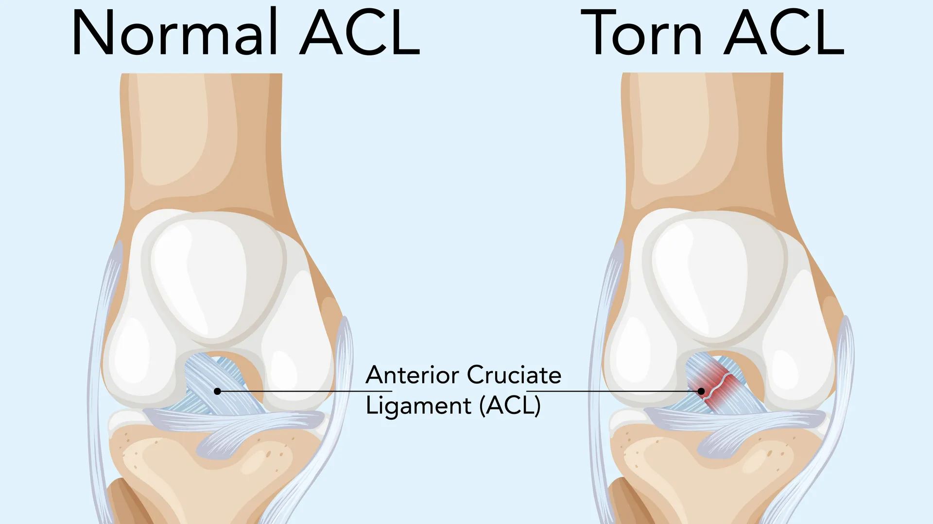 ACL Reconstruction Surgeon in Nagpur
ACL Reconstruction Surgeon in Nagpur – Restore Knee Stability...