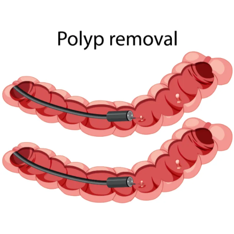 Colonic Polyps Management in Mumbai
