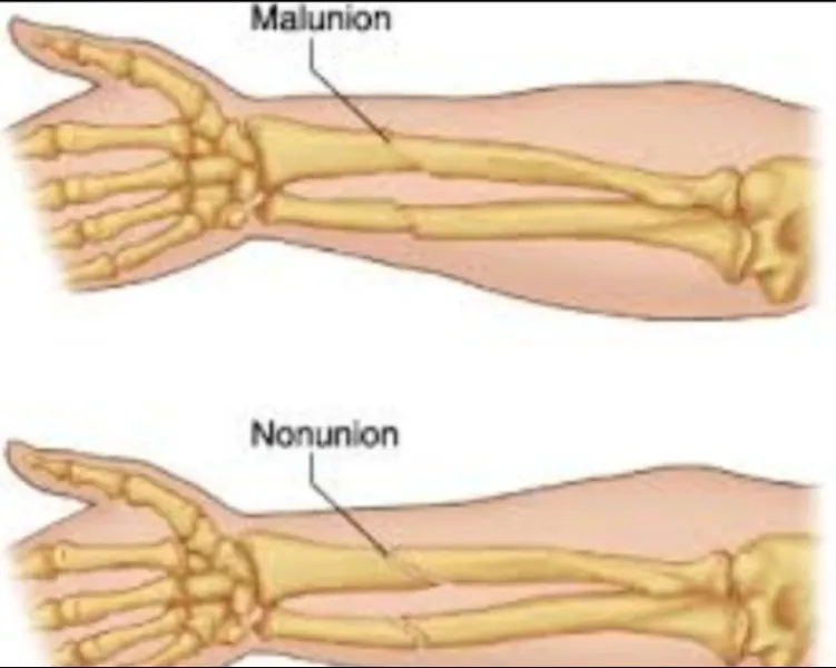 Nonunion and Malunion Treatment in Pimpri-Chinchwad