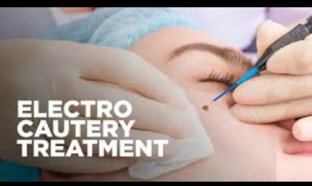 Electrocauterization of Warts in Dhule – Safe & Effective Wart Removal