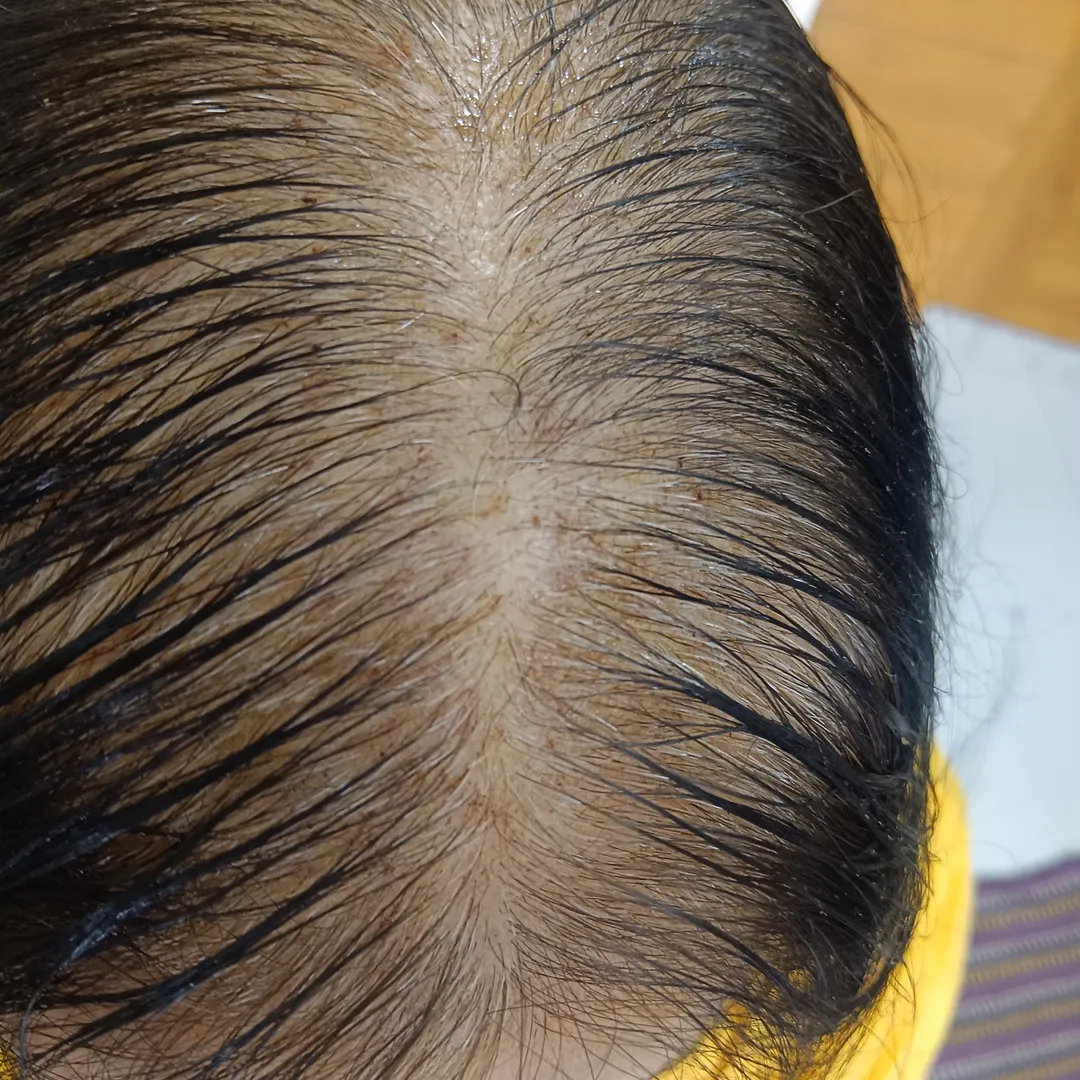 For Hair Regrowth - Methy - Biotin oil