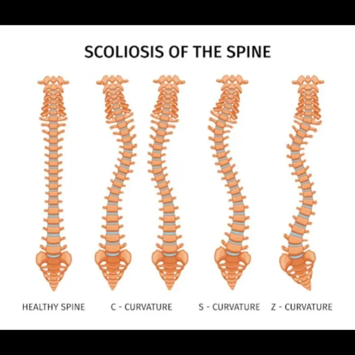 Scoliosis Specialist in Nagpur – SUYOG HOSPITAL NAGPUR