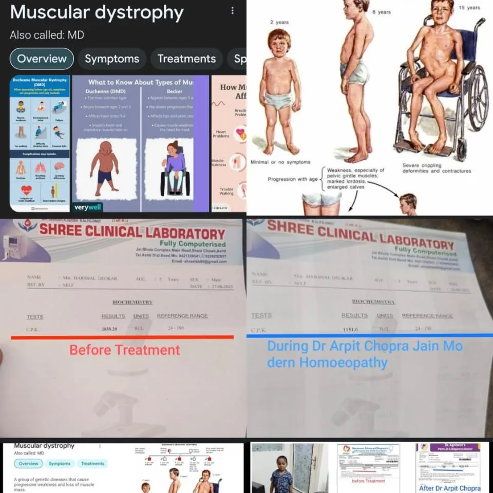 Muscular Dystrophy मस्कुलर डिस्ट्रॉफी High CPK 3038 to 1151 by Dr Arpit Chopra Jain Aarogya Super Sp...