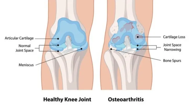 Osteoarthritis Doctor in Kottivakkam – Managing Pain with Precision