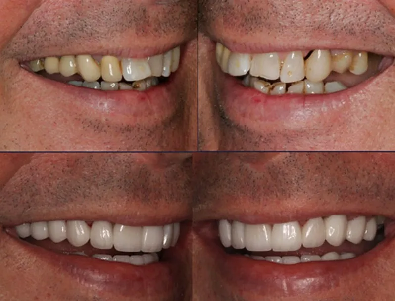 Full Mouth Rehabilitations in Madhura Nagar