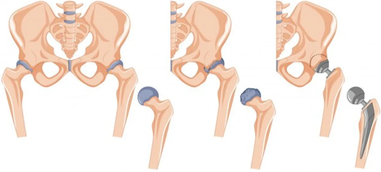 Advanced Total Hip Replacement in Nagarbhavi for Pain-Free Living