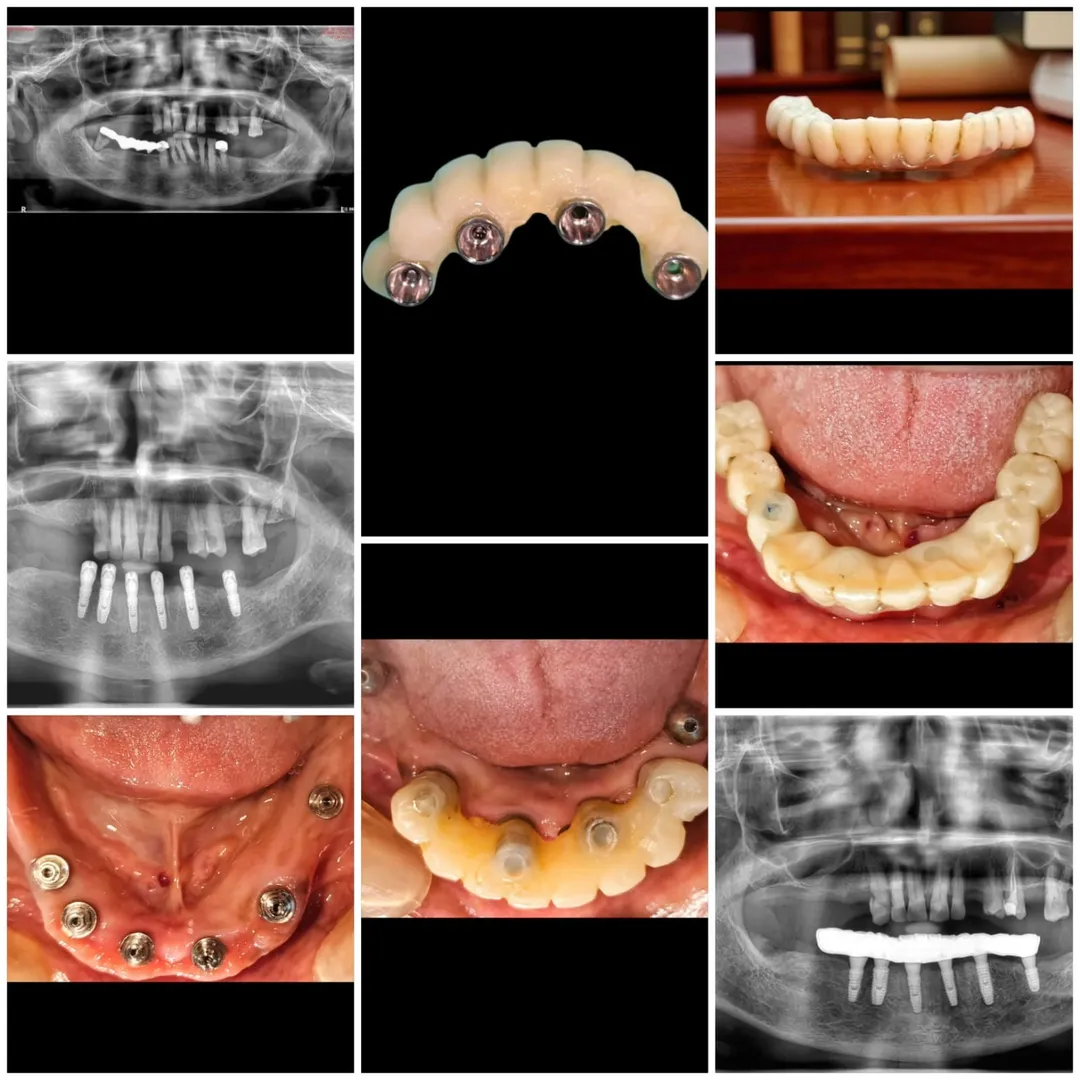 FULL ARCH IMPLANT REHABILITATION IMMEDIATE PLACEMENT & LOADING.
FROM HOPLESS DENTITION TO A CONFIDEN...