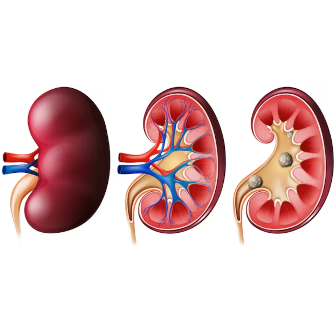 Best Kidney Stone Treatment in Thane – Safe and Effective Solutions