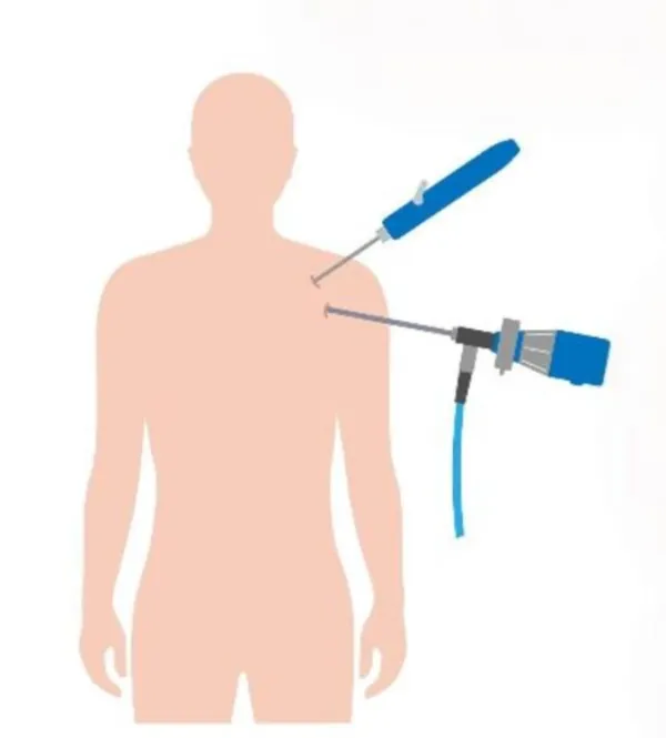 Arthroscopic Bankart Repair in Bangalore – Effective Shoulder Instability Treatment