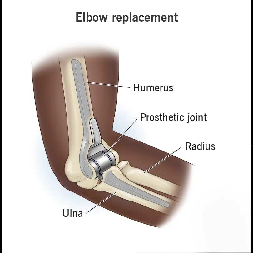 Reliable Elbow Replacement in Nagarbhavi for Long-Term Relief