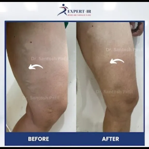 Searching for a vascular surgeon near me or the best vascular surgeon in Pune? Visit The Expert IR C...