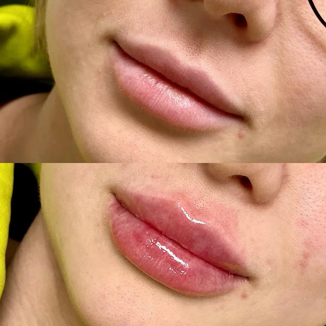 lip filler