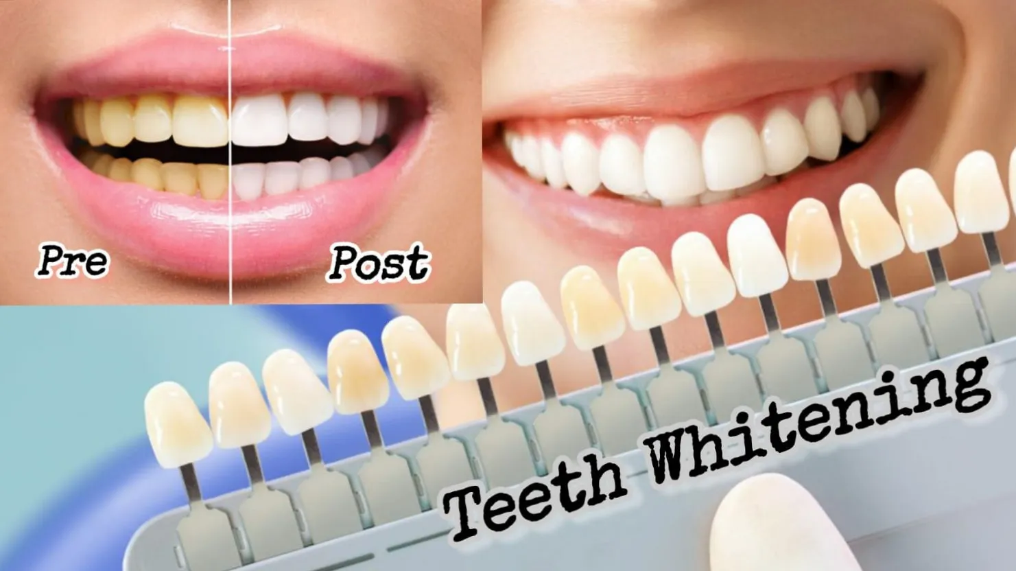Teeth Whitening in Noida – Get a Brighter, Confident Smile at Align & Smile Dental Care