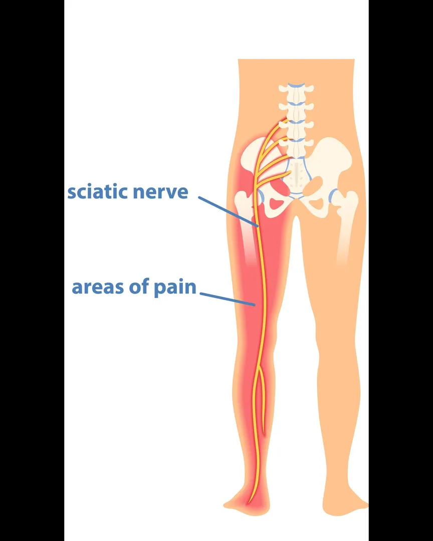 Sciatica Orthopedic Doctor in Nagpur – SUYOG HOSPITAL NAGPUR