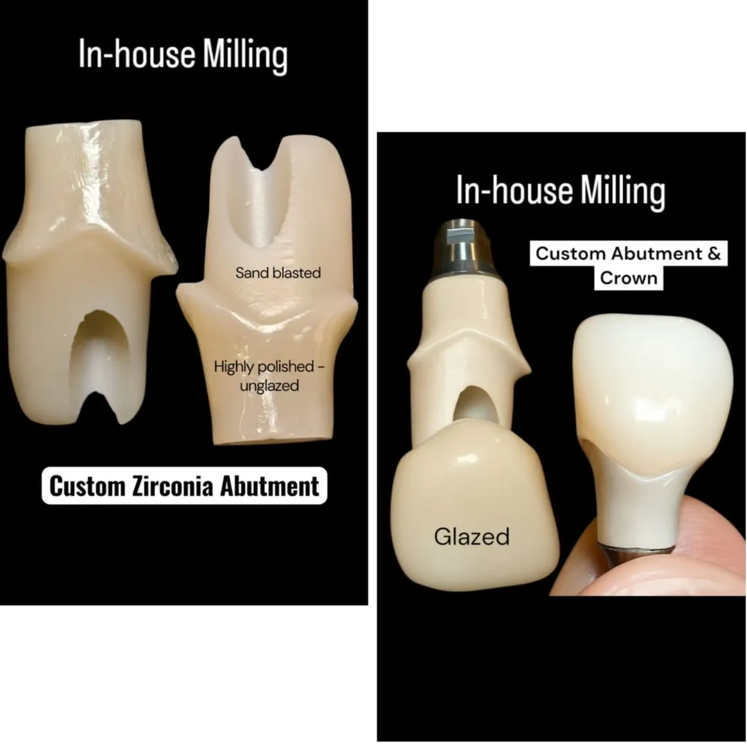 CUSTOM ZIRCONIA CROWN FOR ANTERIOR TOOTH