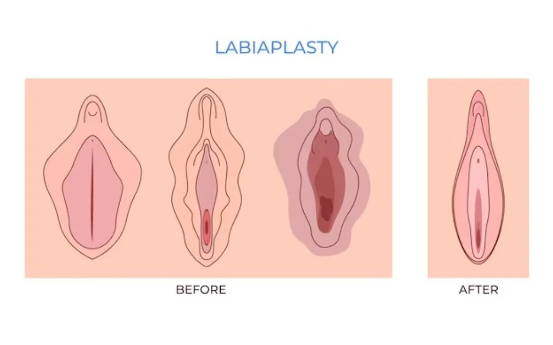 Labiaplasty Surgery in Bangalore – Refine and Reshape with Care