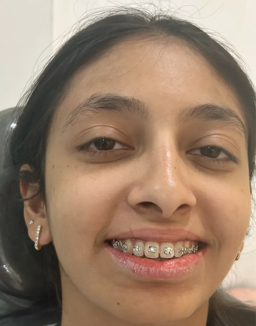 What to Expect After Getting Braces | Dr. Ruchi Noida