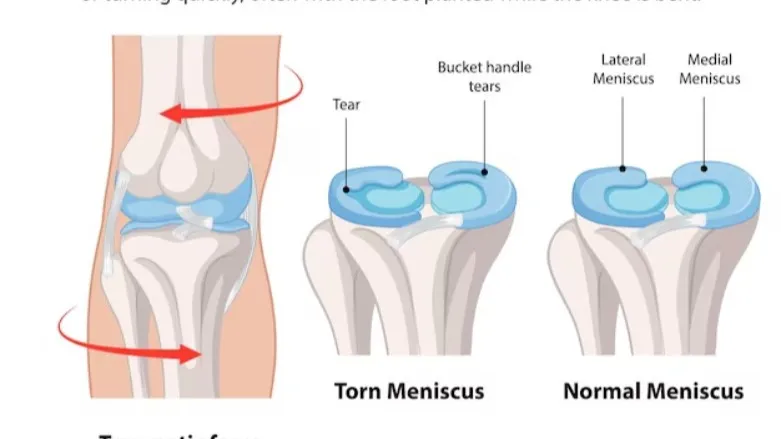 Meniscus Surgery in Noida – Relief for Knee Joint Injuries